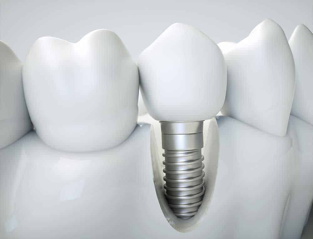 Cara Hinchada por Implantes Dentales: Causas y Soluciones